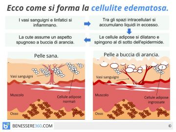 Cellulite edematosa: cause, cure, dieta e rimedi naturali