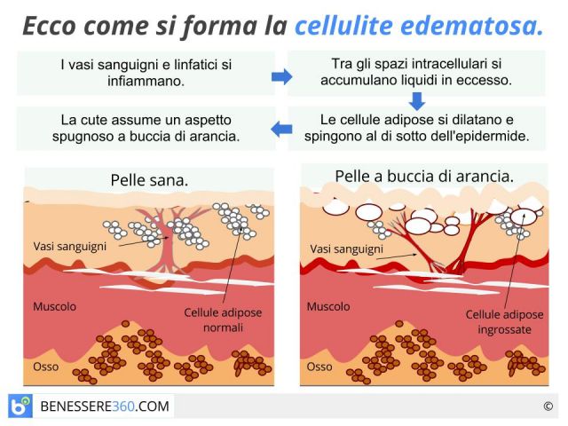 Cellulite edematosa: cause, cure, dieta e rimedi naturali.