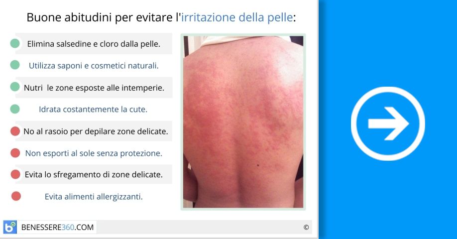 Pelle irritata ed arrossata. Cause e rimedi per l'irritazione cutanea