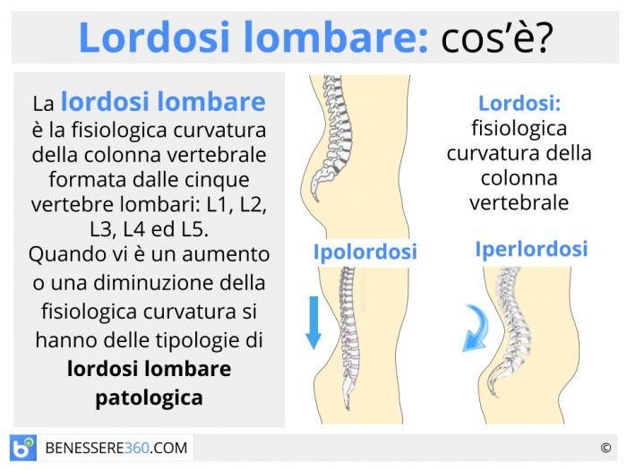 Lordosi Lombare Tipi Sintomi Cura Ed Esercizi