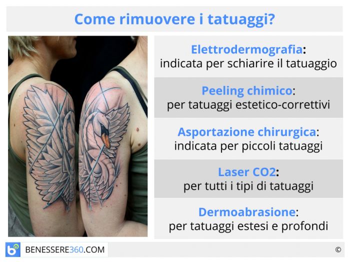 Rimozione tatuaggi crema