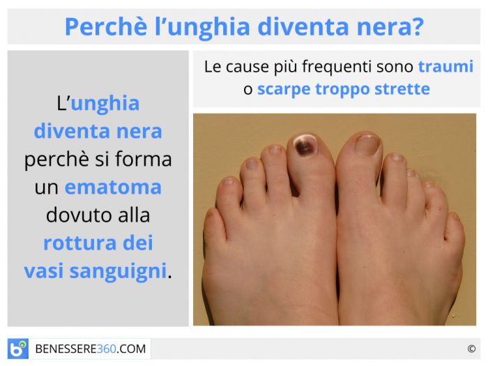 Micosi unghia piede - Problemi delle unghie - DermaClub Forum