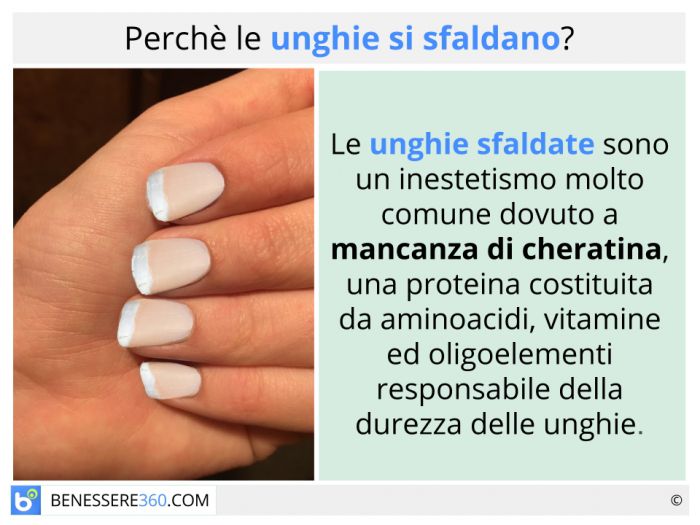 psoriasi unghie mani rimedi naturali